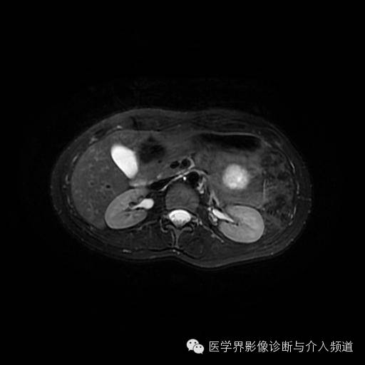【病例】胰腺实性假乳头状瘤1例MR影像表现 【病例】胰腺实性假乳头状瘤1例MR影像表现