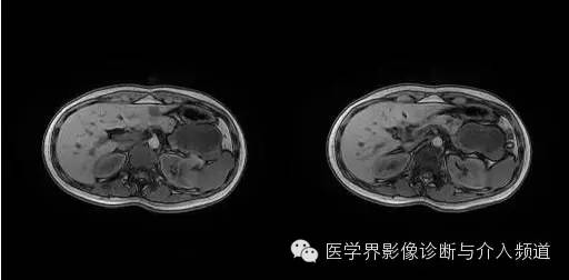 【病例】胰腺实性假乳头状瘤1例MR影像表现 【病例】胰腺实性假乳头状瘤1例MR影像表现
