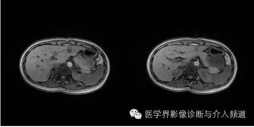 【病例】胰腺实性假乳头状瘤1例MR影像表现 【病例】胰腺实性假乳头状瘤1例MR影像表现
