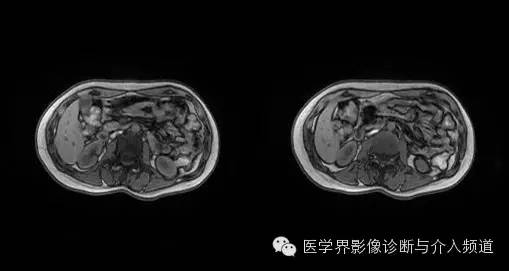 【病例】胰腺实性假乳头状瘤1例MR影像表现 【病例】胰腺实性假乳头状瘤1例MR影像表现