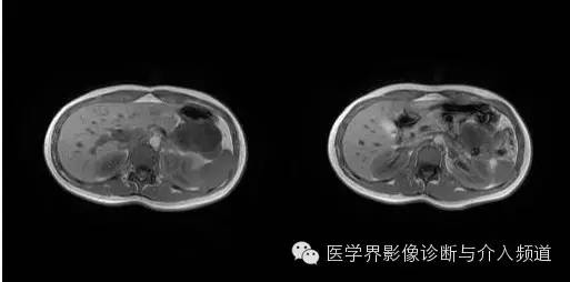 【病例】胰腺实性假乳头状瘤1例MR影像表现 【病例】胰腺实性假乳头状瘤1例MR影像表现