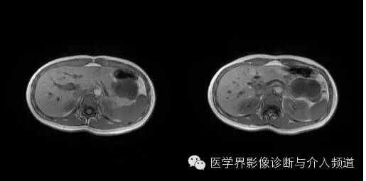 【病例】胰腺实性假乳头状瘤1例MR影像表现 【病例】胰腺实性假乳头状瘤1例MR影像表现