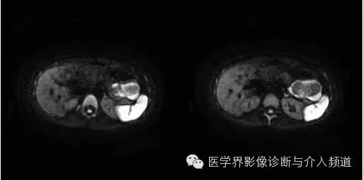 【病例】胰腺实性假乳头状瘤1例MR影像表现 【病例】胰腺实性假乳头状瘤1例MR影像表现