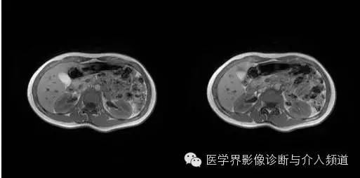 【病例】胰腺实性假乳头状瘤1例MR影像表现 【病例】胰腺实性假乳头状瘤1例MR影像表现