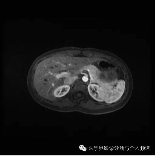 【病例】胰腺实性假乳头状瘤1例MR影像表现 【病例】胰腺实性假乳头状瘤1例MR影像表现