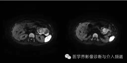 【病例】胰腺实性假乳头状瘤1例MR影像表现 【病例】胰腺实性假乳头状瘤1例MR影像表现