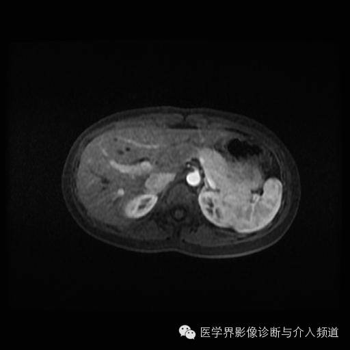 【病例】胰腺实性假乳头状瘤1例MR影像表现 【病例】胰腺实性假乳头状瘤1例MR影像表现