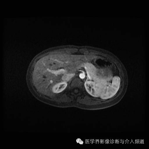 【病例】胰腺实性假乳头状瘤1例MR影像表现 【病例】胰腺实性假乳头状瘤1例MR影像表现