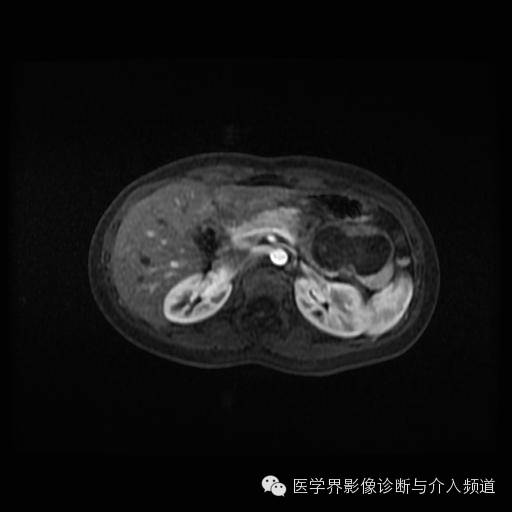 【病例】胰腺实性假乳头状瘤1例MR影像表现 【病例】胰腺实性假乳头状瘤1例MR影像表现