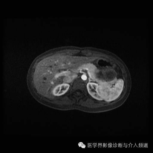 【病例】胰腺实性假乳头状瘤1例MR影像表现 【病例】胰腺实性假乳头状瘤1例MR影像表现