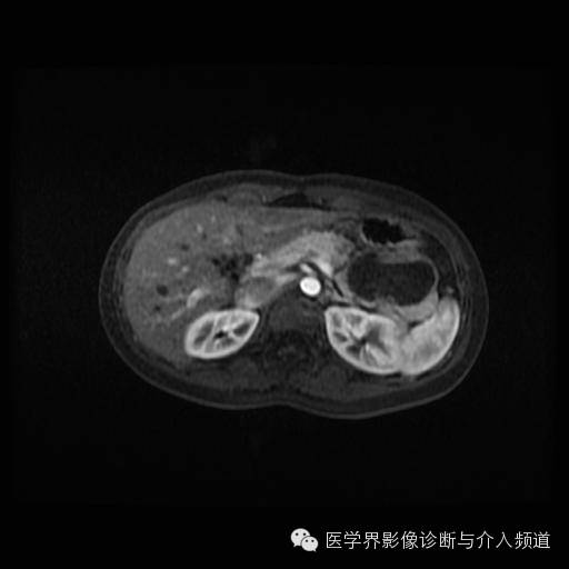 【病例】胰腺实性假乳头状瘤1例MR影像表现 【病例】胰腺实性假乳头状瘤1例MR影像表现