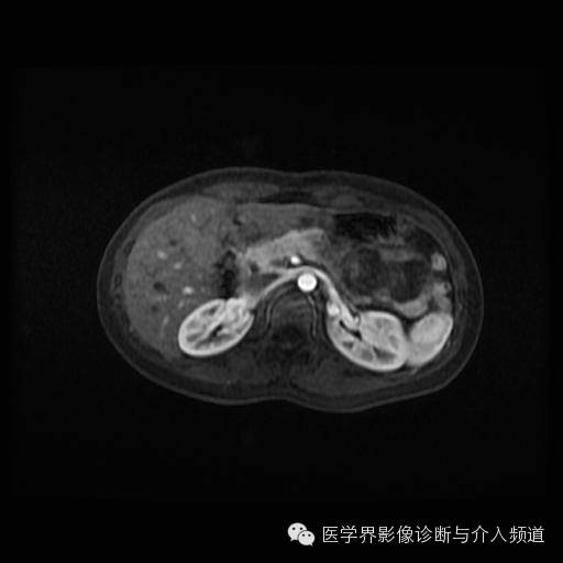 【病例】胰腺实性假乳头状瘤1例MR影像表现 【病例】胰腺实性假乳头状瘤1例MR影像表现