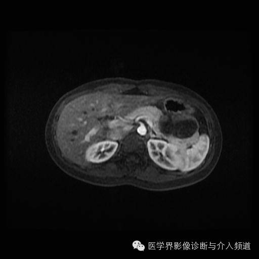 【病例】胰腺实性假乳头状瘤1例MR影像表现 【病例】胰腺实性假乳头状瘤1例MR影像表现