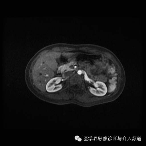 【病例】胰腺实性假乳头状瘤1例MR影像表现 【病例】胰腺实性假乳头状瘤1例MR影像表现