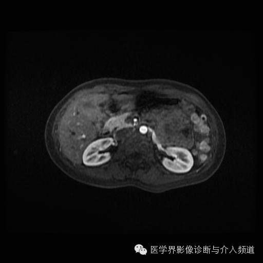 【病例】胰腺实性假乳头状瘤1例MR影像表现 【病例】胰腺实性假乳头状瘤1例MR影像表现