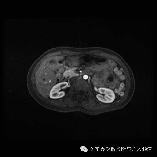 【病例】胰腺实性假乳头状瘤1例MR影像表现 【病例】胰腺实性假乳头状瘤1例MR影像表现