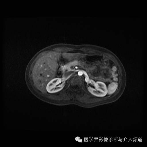 【病例】胰腺实性假乳头状瘤1例MR影像表现 【病例】胰腺实性假乳头状瘤1例MR影像表现