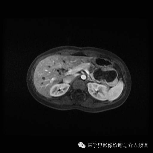 【病例】胰腺实性假乳头状瘤1例MR影像表现 【病例】胰腺实性假乳头状瘤1例MR影像表现