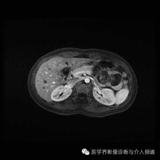 【病例】胰腺实性假乳头状瘤1例MR影像表现 【病例】胰腺实性假乳头状瘤1例MR影像表现