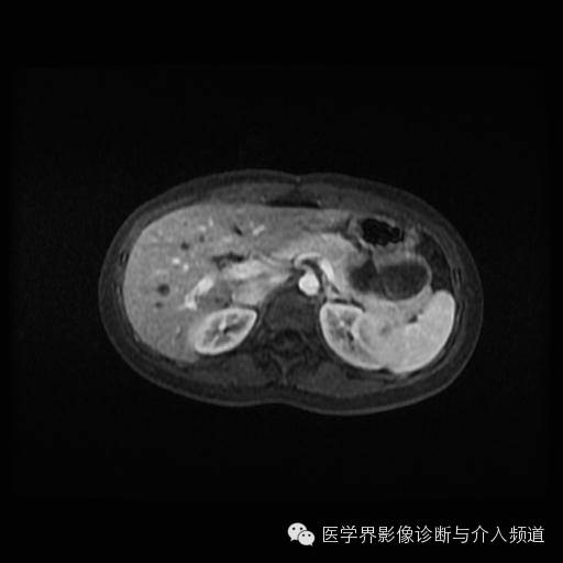 【病例】胰腺实性假乳头状瘤1例MR影像表现 【病例】胰腺实性假乳头状瘤1例MR影像表现