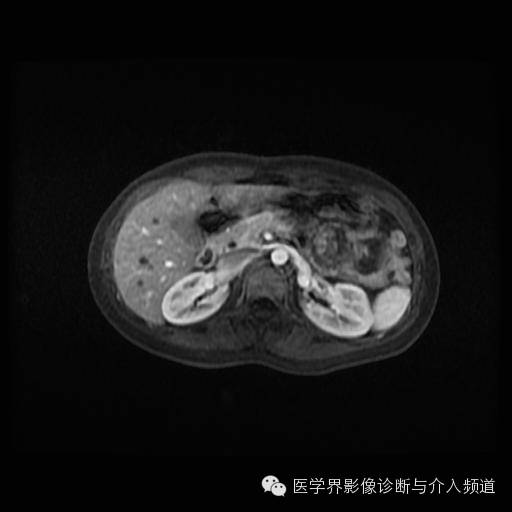 【病例】胰腺实性假乳头状瘤1例MR影像表现 【病例】胰腺实性假乳头状瘤1例MR影像表现