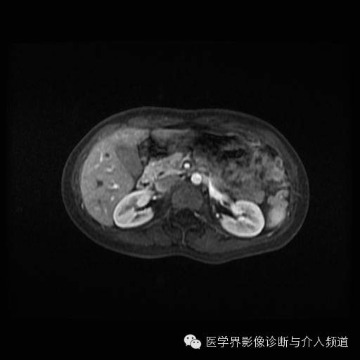 【病例】胰腺实性假乳头状瘤1例MR影像表现 【病例】胰腺实性假乳头状瘤1例MR影像表现