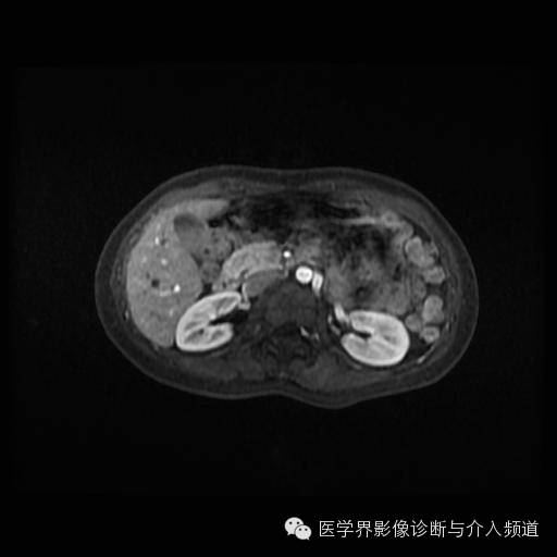 【病例】胰腺实性假乳头状瘤1例MR影像表现 【病例】胰腺实性假乳头状瘤1例MR影像表现