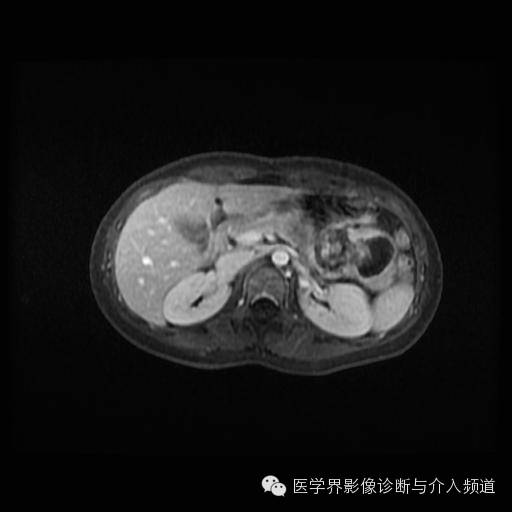【病例】胰腺实性假乳头状瘤1例MR影像表现 【病例】胰腺实性假乳头状瘤1例MR影像表现