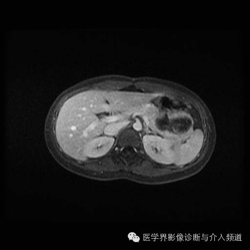 【病例】胰腺实性假乳头状瘤1例MR影像表现 【病例】胰腺实性假乳头状瘤1例MR影像表现