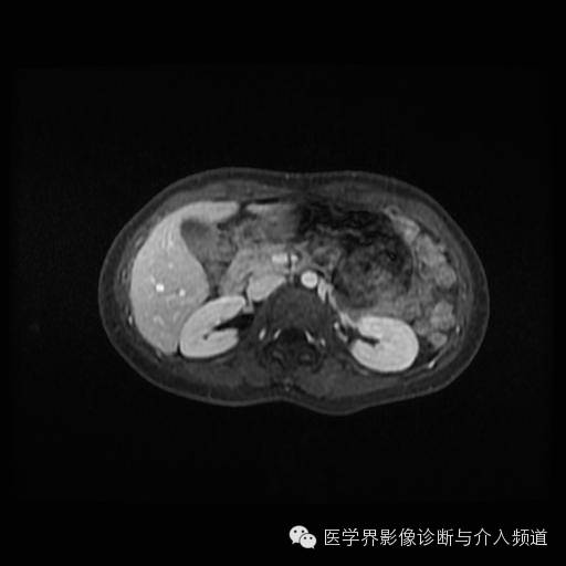 【病例】胰腺实性假乳头状瘤1例MR影像表现 【病例】胰腺实性假乳头状瘤1例MR影像表现