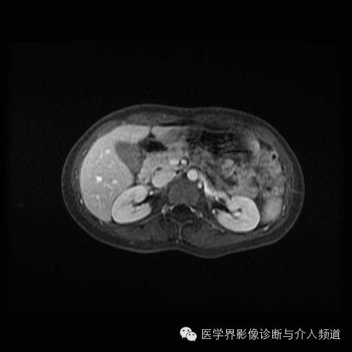 【病例】胰腺实性假乳头状瘤1例MR影像表现 【病例】胰腺实性假乳头状瘤1例MR影像表现