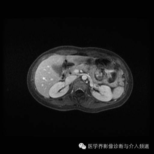 【病例】胰腺实性假乳头状瘤1例MR影像表现 【病例】胰腺实性假乳头状瘤1例MR影像表现