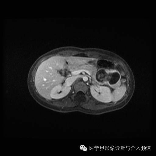 【病例】胰腺实性假乳头状瘤1例MR影像表现 【病例】胰腺实性假乳头状瘤1例MR影像表现