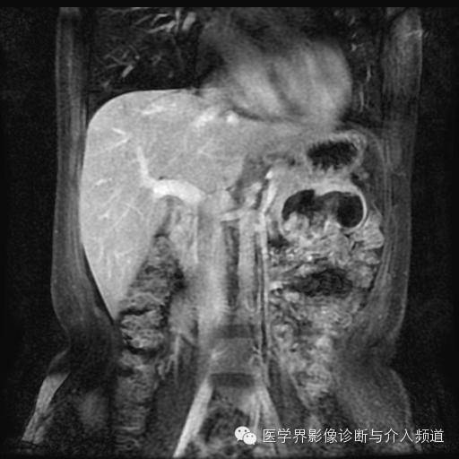 【病例】胰腺实性假乳头状瘤1例MR影像表现 【病例】胰腺实性假乳头状瘤1例MR影像表现