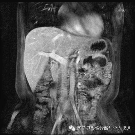 【病例】胰腺实性假乳头状瘤1例MR影像表现 【病例】胰腺实性假乳头状瘤1例MR影像表现