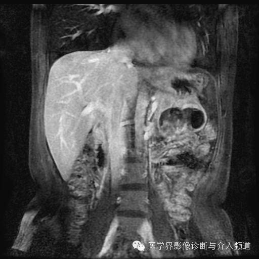 【病例】胰腺实性假乳头状瘤1例MR影像表现 【病例】胰腺实性假乳头状瘤1例MR影像表现