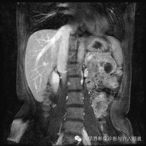 【病例】胰腺实性假乳头状瘤1例MR影像表现 【病例】胰腺实性假乳头状瘤1例MR影像表现