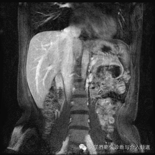 【病例】胰腺实性假乳头状瘤1例MR影像表现 【病例】胰腺实性假乳头状瘤1例MR影像表现