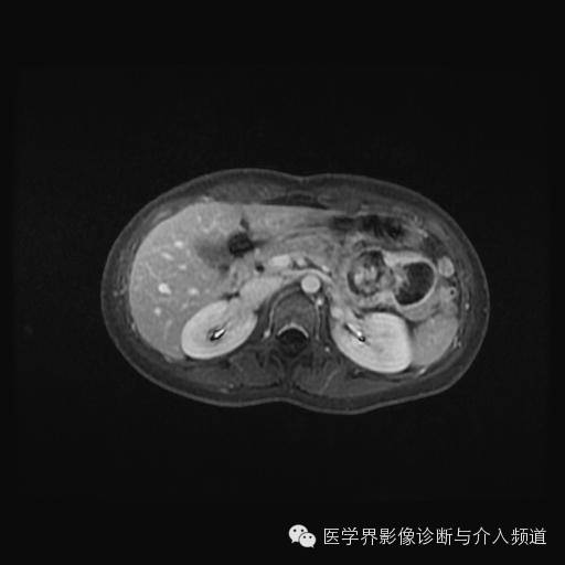【病例】胰腺实性假乳头状瘤1例MR影像表现 【病例】胰腺实性假乳头状瘤1例MR影像表现