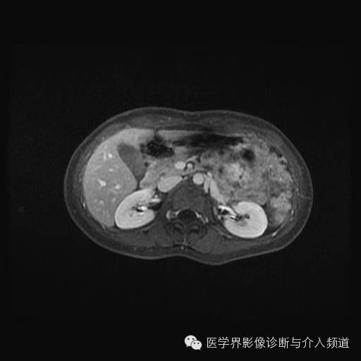 【病例】胰腺实性假乳头状瘤1例MR影像表现 【病例】胰腺实性假乳头状瘤1例MR影像表现