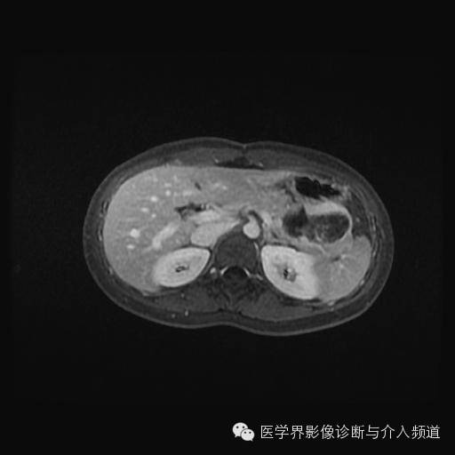 【病例】胰腺实性假乳头状瘤1例MR影像表现 【病例】胰腺实性假乳头状瘤1例MR影像表现