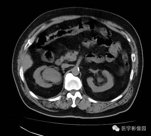 【病例】肾盂癌1例CT影像表现