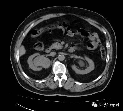 【病例】肾盂癌1例CT影像表现 【病例】肾盂癌1例CT影像表现