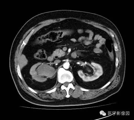 【病例】肾盂癌1例CT影像表现 【病例】肾盂癌1例CT影像表现