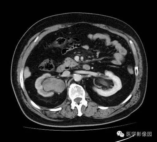 【病例】肾盂癌1例CT影像表现 【病例】肾盂癌1例CT影像表现