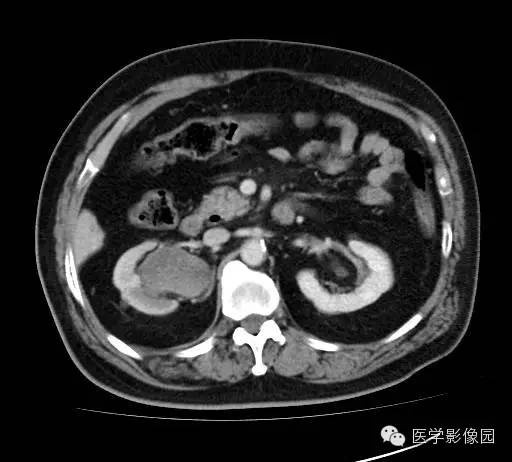 【病例】肾盂癌1例CT影像表现 【病例】肾盂癌1例CT影像表现
