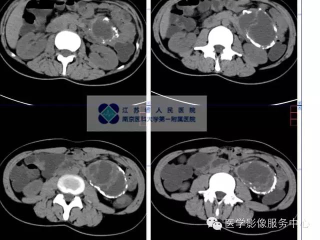 【病例】胰腺实性假乳头状肿瘤1例CT影像表现