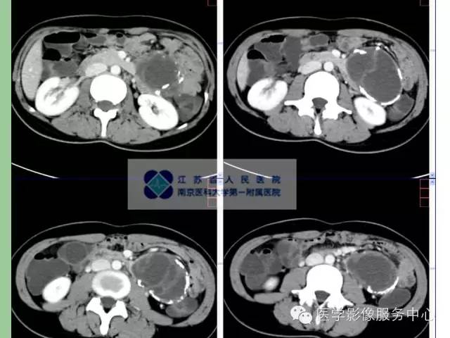 【病例】胰腺实性假乳头状肿瘤1例CT影像表现 【病例】胰腺实性假乳头状肿瘤1例CT影像表现