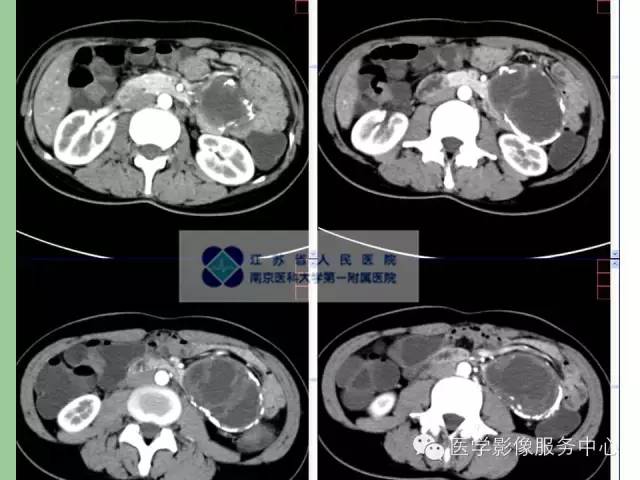 【病例】胰腺实性假乳头状肿瘤1例CT影像表现 【病例】胰腺实性假乳头状肿瘤1例CT影像表现