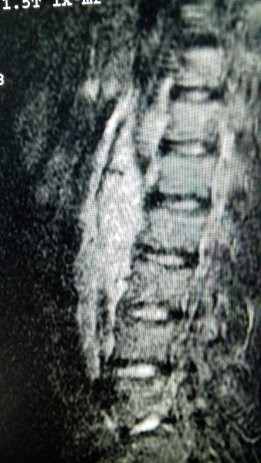 【病例】淋巴瘤1例MR影像表现 【病例】淋巴瘤1例MR影像表现